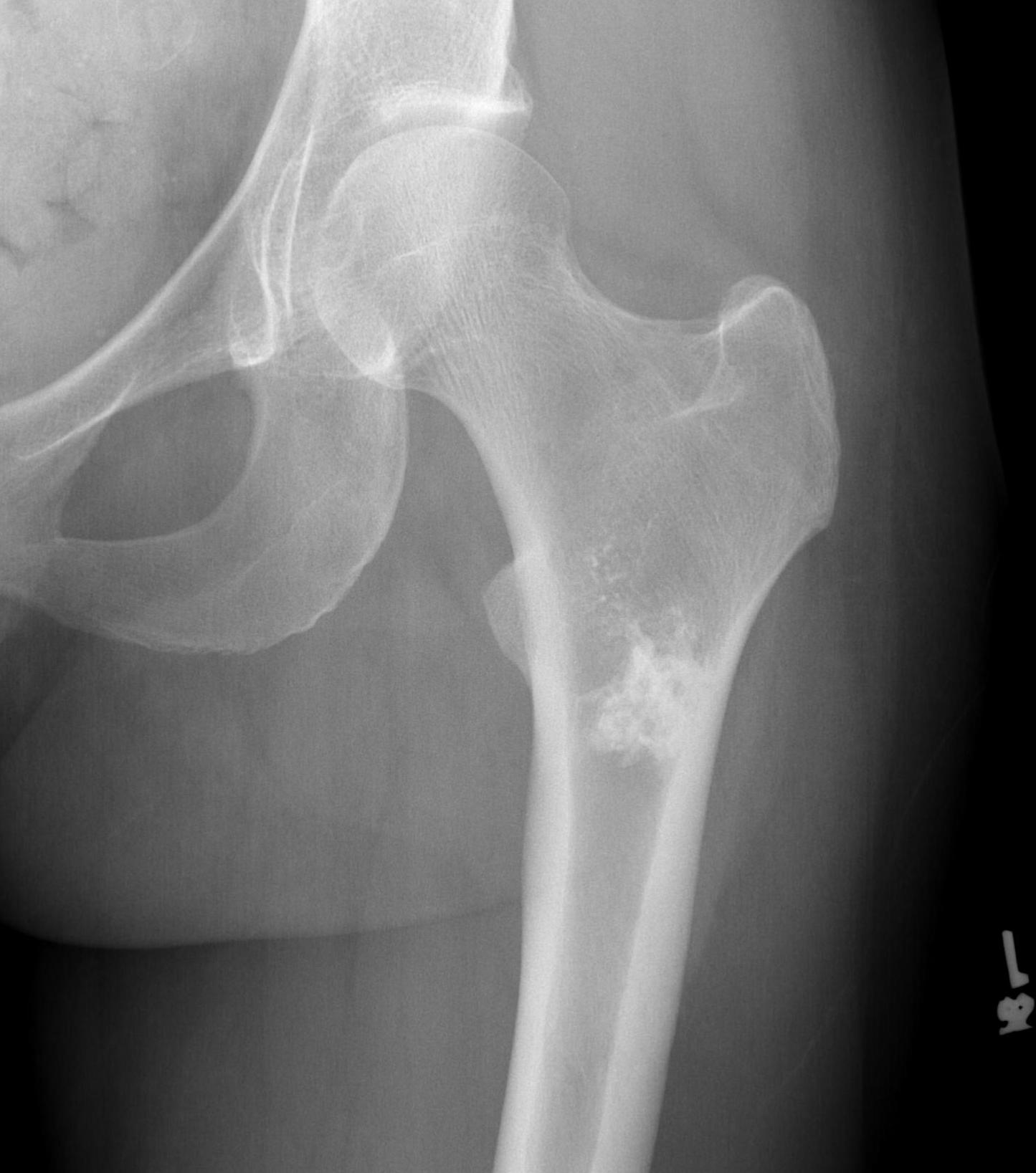 Enchondroma Hip